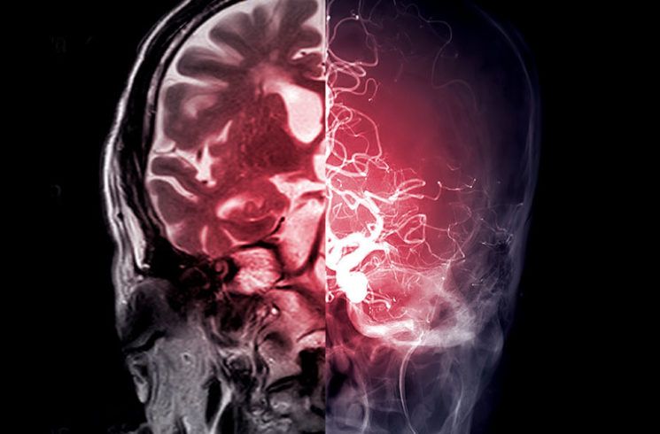 Estimulación cerebral profunda es alentadora para pacientes con accidente cerebrovascular: Cleveland Clinic