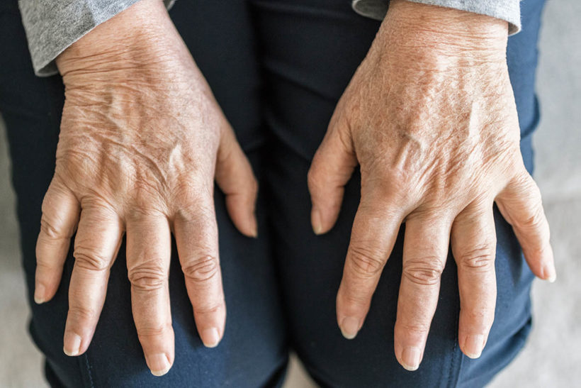 Osteoporosis postmenopáusica: un desafío de salud para las mujeres en México