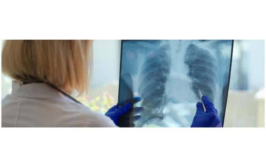 Atención de comorbilidades mejora el pronóstico de vida en pacientes con Fibrosis Pulmonar