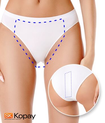 Tecnología YAG Candela facilita depilacion bikini brasileño en Kopay de Gele Giner