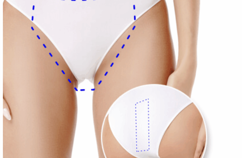 Kopay: depilación láser de barba, axilas y bikini en tendencia
