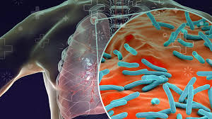 Diagnóstico oportuno: la clave para frenar la doble amenaza del VIH y la tuberculosis. El arte de disfrutar con estilo y sentido.